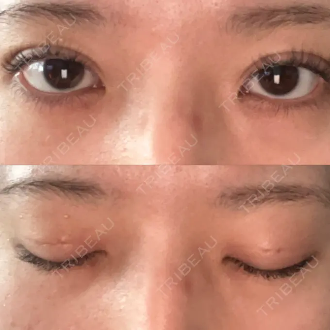 二重埋没 / ハイフ（顔） 日本ウェルネス再生クリニック DAY 4 メイン用