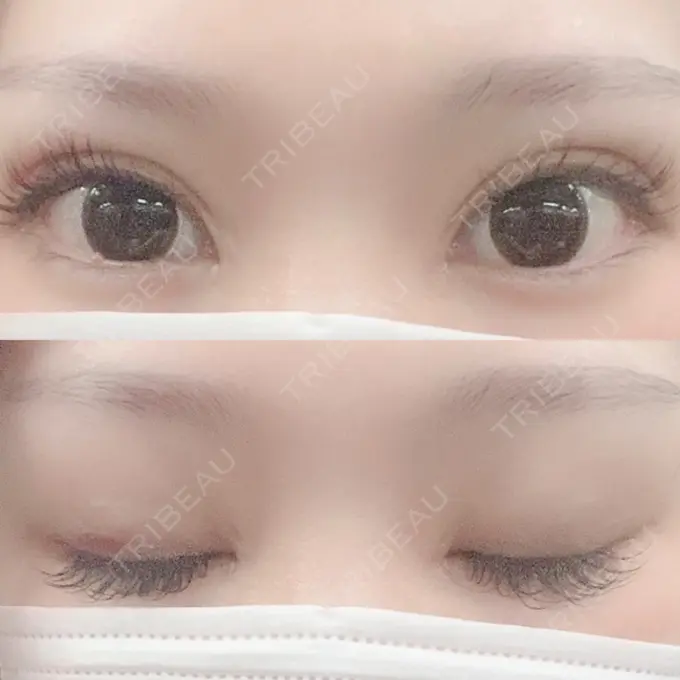 二重埋没 / 目頭切開 Brandnew Beauty Clinic DAY 9 メイン用