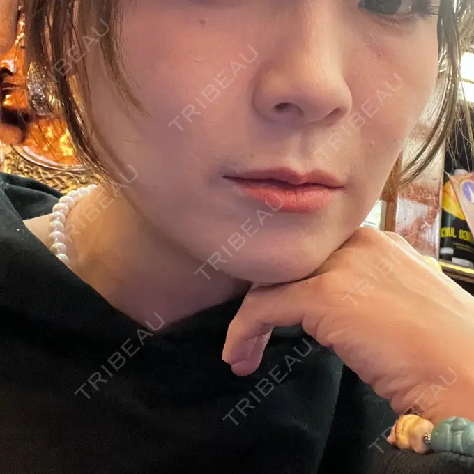 糸リフト 東京シンデレラ美容外科 池袋院 AFTER メイン用