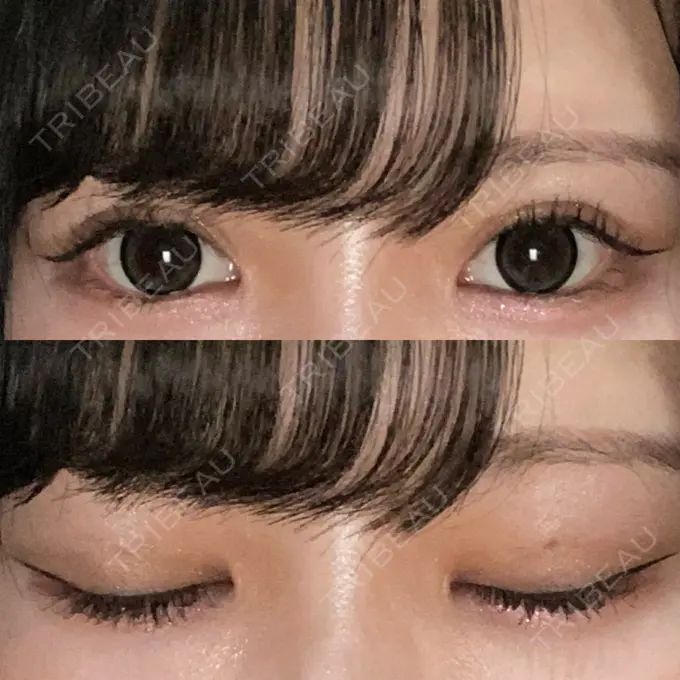 二重埋没 日本ウェルネス再生クリニック DAY 5 メイン用