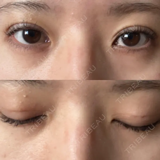 二重埋没 / ハイフ（顔） 日本ウェルネス再生クリニック DAY 5 メイン用