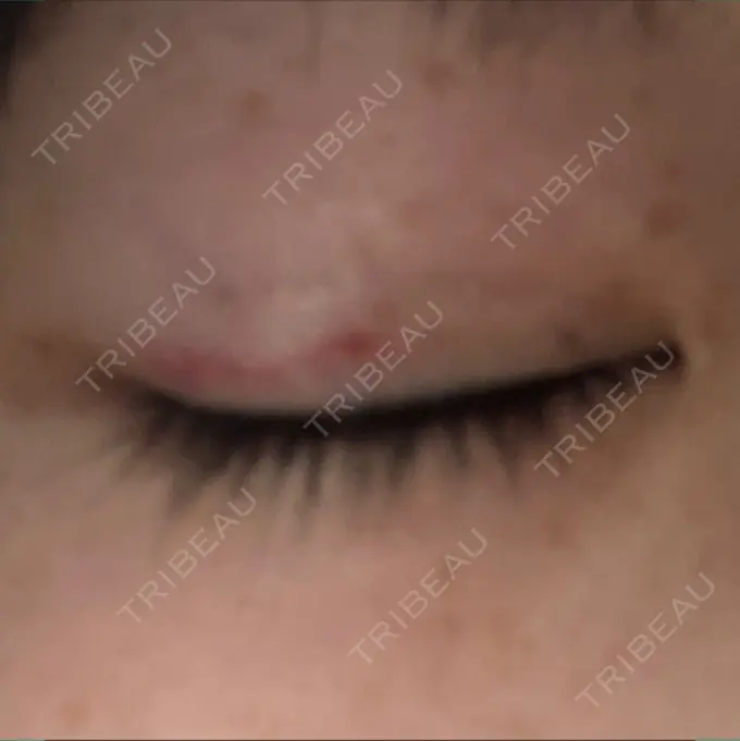 二重埋没 品川スキンクリニック広島院 DAY 8 メイン用