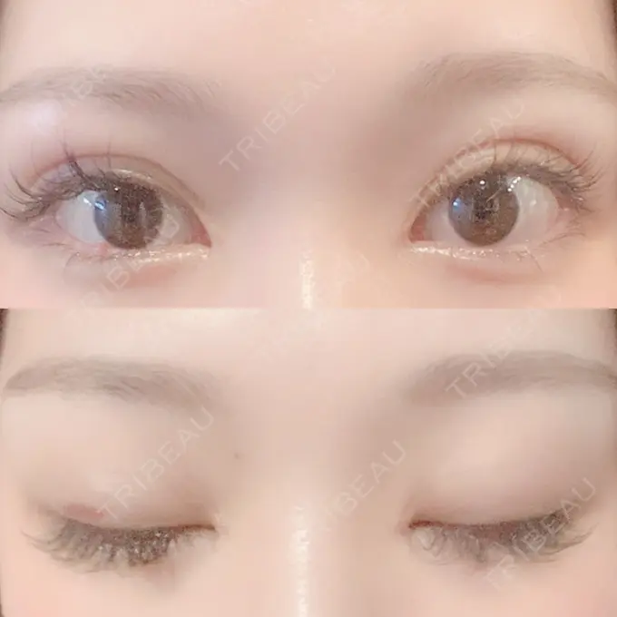 二重埋没 / 目頭切開 Brandnew Beauty Clinic DAY 10 メイン用