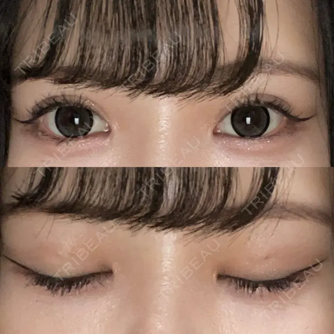 二重埋没 日本ウェルネス再生クリニック DAY 6 メイン用