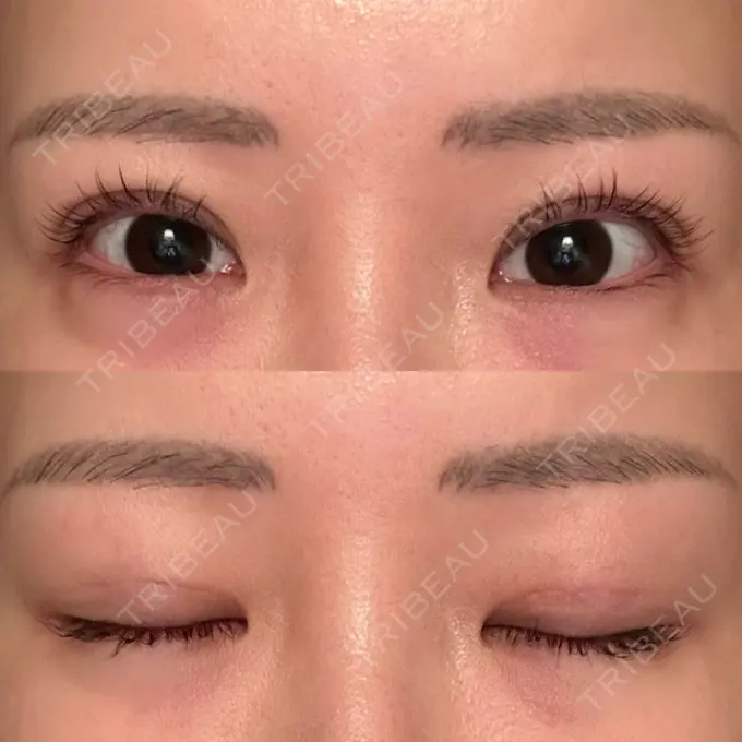 二重埋没 品川スキンクリニック 宇都宮院（※品川美容外科提携） DAY 18 メイン用