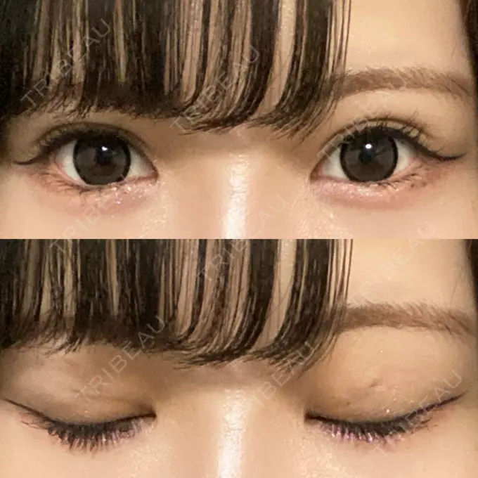 二重埋没 日本ウェルネス再生クリニック AFTER メイン用