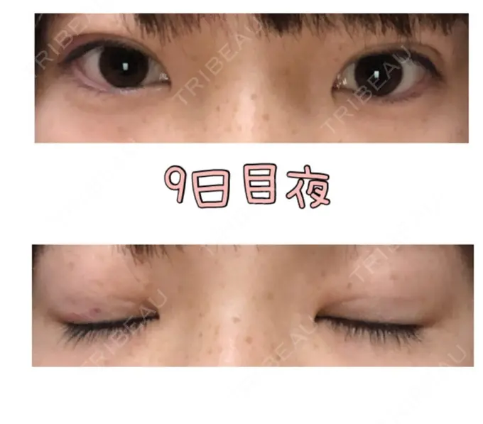 二重埋没 品川スキンクリニック広島院 DAY 9 メイン用