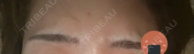 ボトックス（眉間） 湘南美容クリニック 博多院 DAY 2 メイン用