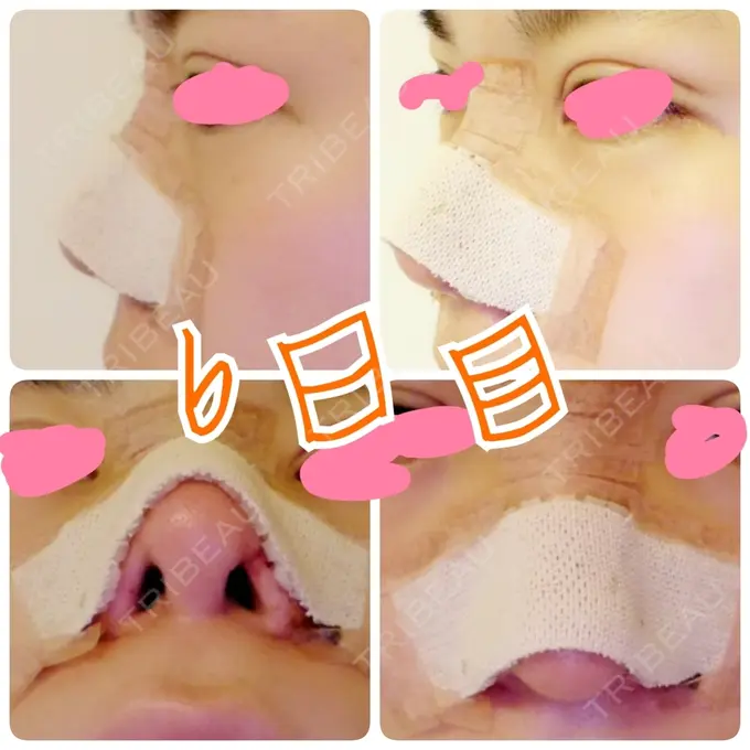 隆鼻術 / 鼻尖形成（切開） / 鼻尖縮小 ヤスミクリニック DAY 6 メイン用