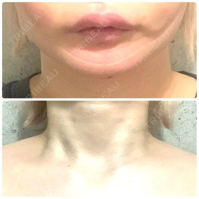 ボトックス（エラ・小顔） / ボトックス（肩） ルラ美容クリニック 上野院 DAY 5 メイン用