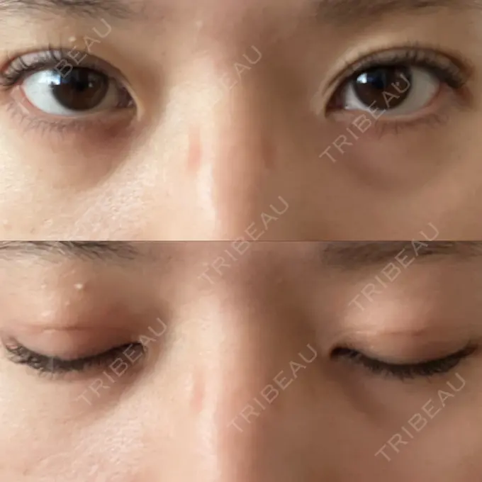 二重埋没 / ハイフ（顔） 日本ウェルネス再生クリニック DAY 7 メイン用