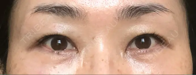 クマ治療 / 下まぶたたるみ取り / 下まぶたの脂肪取り / 目元修正 / その他（目元） 吉井クリニック DAY 48 メイン用