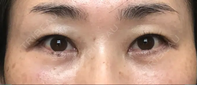 クマ治療 / 下まぶたたるみ取り / 下まぶたの脂肪取り / 目元修正 / その他（目元） 吉井クリニック DAY 64 メイン用