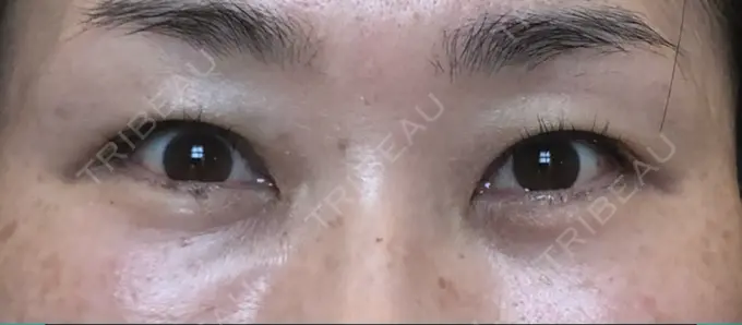 クマ治療 / 下まぶたたるみ取り / 下まぶたの脂肪取り / 目元修正 / その他（目元） 吉井クリニック DAY 64 メイン用