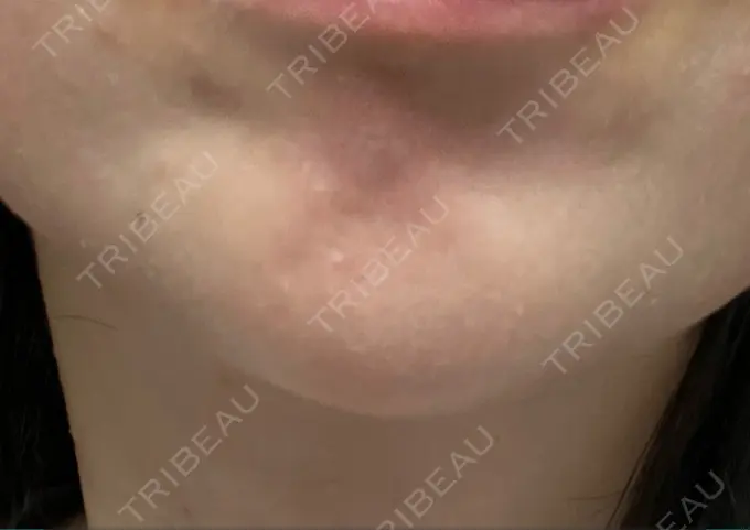 ボトックス（あご） 湘南美容クリニック 大阪あべの院 AFTER メイン用