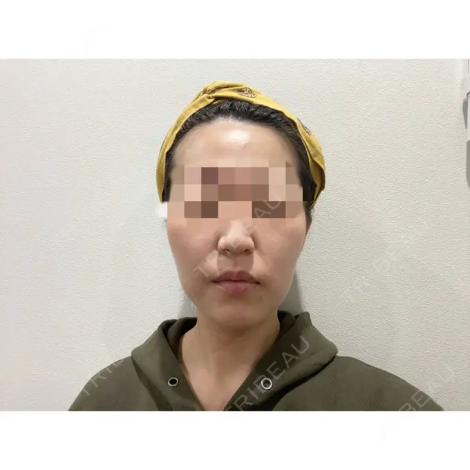 糸リフト / 脂肪吸引（顔） / ジョールファット除去 / ボトックス（エラ・小顔） WOM CLINIC GINZA （ワム クリニック ギンザ） DAY 94 メイン用