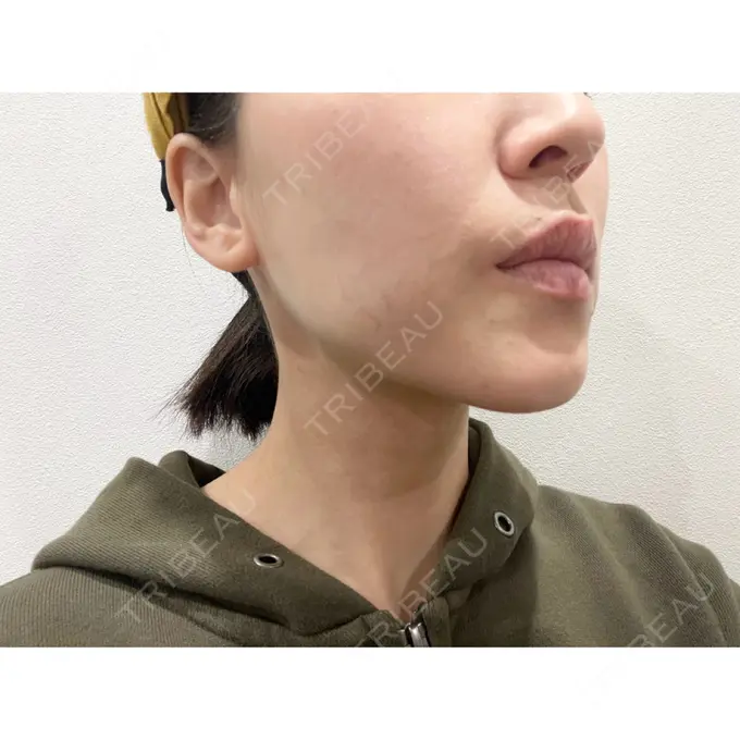 糸リフト / 脂肪吸引（顔） / ジョールファット除去 / ボトックス（エラ・小顔） WOM CLINIC GINZA （ワム クリニック ギンザ） DAY 94 メイン用