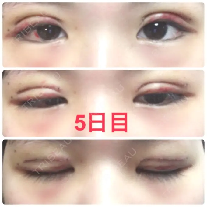 二重切開 品川スキンクリニック広島院 DAY 5 メイン用