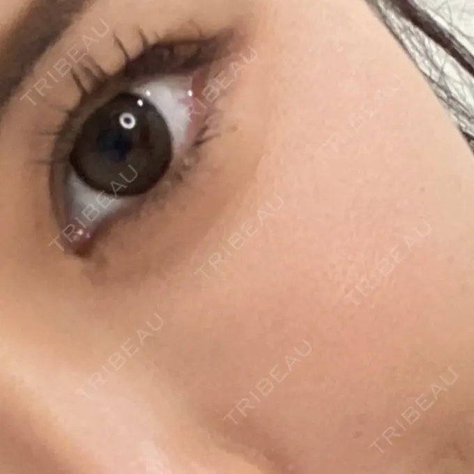 ベビーコラーゲン Mavie Beauty Clinic （マヴィービューティークリニック） AFTER メイン用