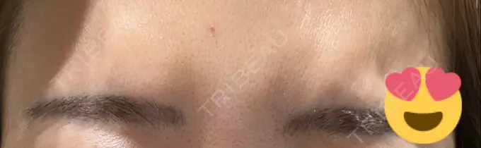 ボトックス（眉間） 湘南美容クリニック 博多院 DAY 4 メイン用