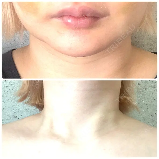 ボトックス（エラ・小顔） / ボトックス（肩） ルラ美容クリニック 上野院 DAY 6 メイン用