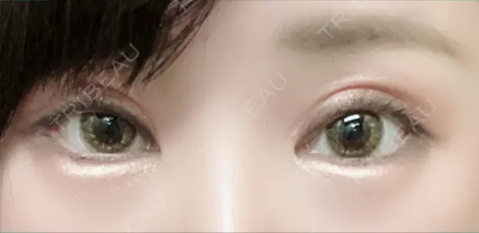 二重切開 / 眼瞼下垂（切開） / 目尻切開 / タレ目形成・グラマラスライン（切開） / 前額リフト レアート整形外科 DAY 25 メイン用