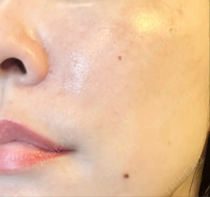 ボトックス（目尻） / ピーリング（ハリ・ツヤ） MYCLINIC 西新宿 DAY 0 メイン用