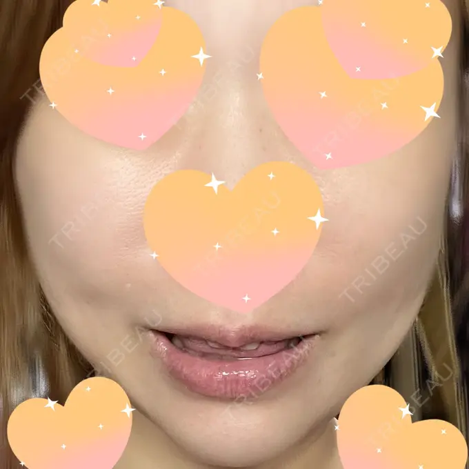 シワ取りボトックス みずほクリニック AFTER メイン用