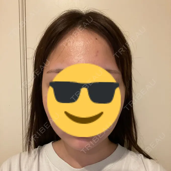 糸リフト / 脂肪吸引（顔） Casa de GRACIA GINZA 【カーサデグラシアギンザ】 DAY 30 メイン用