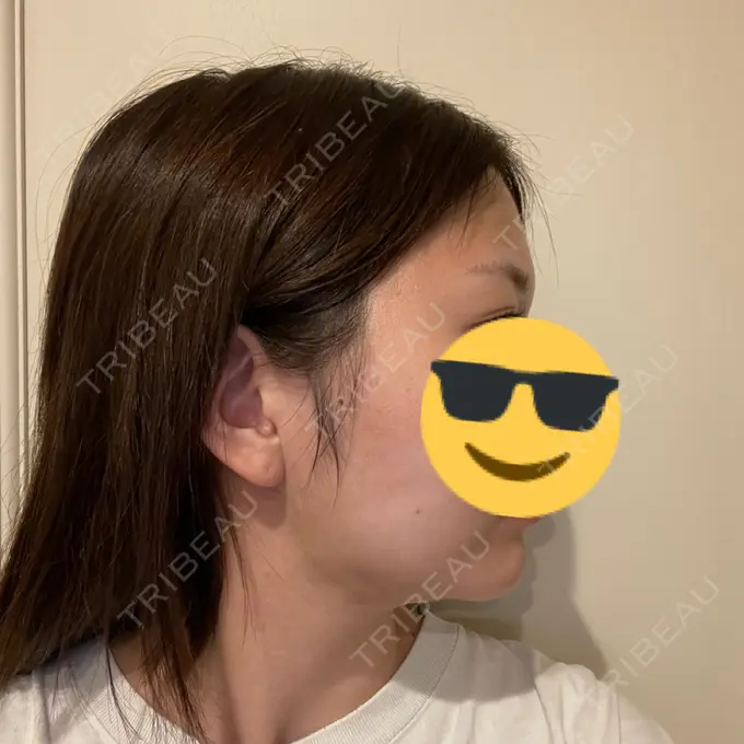 糸リフト / 脂肪吸引（顔） Casa de GRACIA GINZA 【カーサデグラシアギンザ】 DAY 30 メイン用