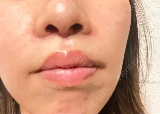 小鼻縮小（切開） / 人中短縮 / 鼻翼挙上 Otus Clinic 【オータスクリニック】 DAY 9 メイン用