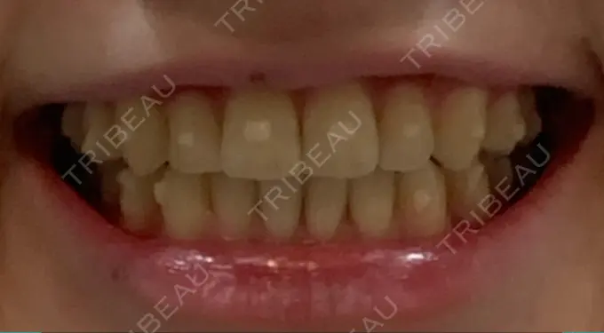 矯正（マウスピース） スマイルプランさくら歯科クリニック DAY 63 メイン用