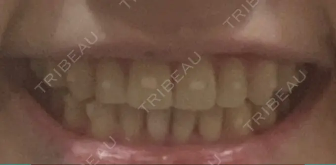 矯正（マウスピース） スマイルプランさくら歯科クリニック DAY 74 メイン用