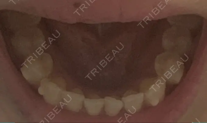 矯正（マウスピース） スマイルプランさくら歯科クリニック DAY 74 メイン用