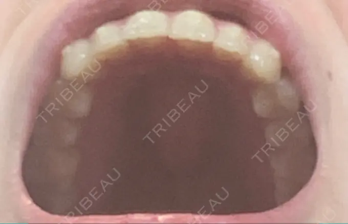 矯正（マウスピース） スマイルプランさくら歯科クリニック DAY 74 メイン用