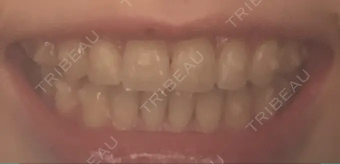 矯正（マウスピース） スマイルプランさくら歯科クリニック DAY 88 メイン用