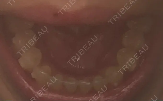 矯正（マウスピース） スマイルプランさくら歯科クリニック DAY 88 メイン用