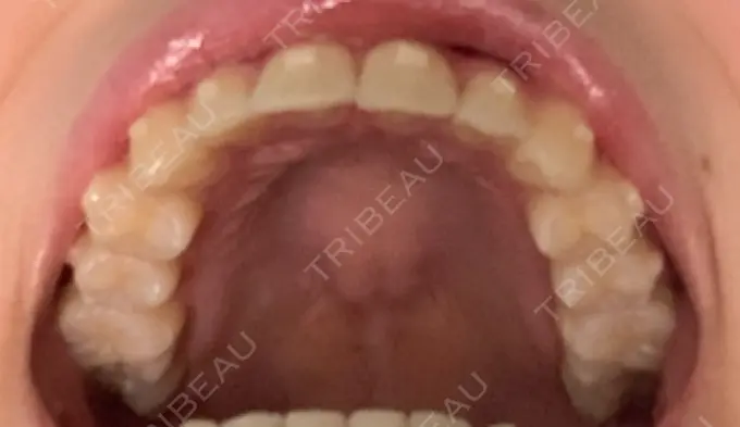 矯正（マウスピース） スマイルプランさくら歯科クリニック DAY 88 メイン用