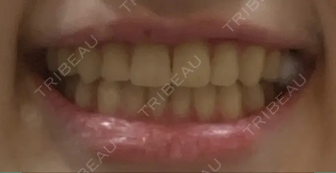 矯正（マウスピース） スマイルプランさくら歯科クリニック AFTER メイン用