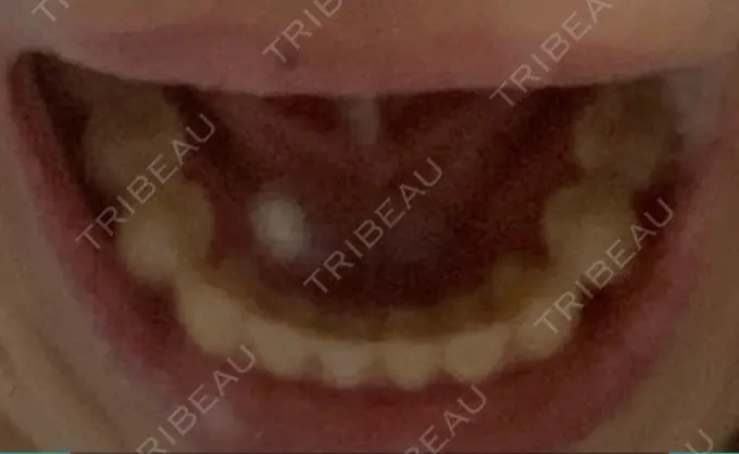 矯正（マウスピース） スマイルプランさくら歯科クリニック DAY 286 メイン用