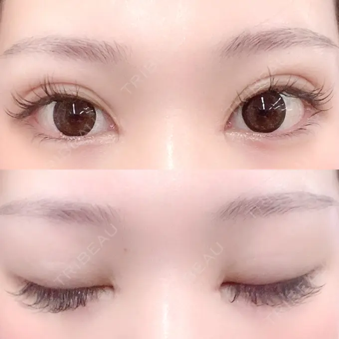 二重埋没 / 目頭切開 Brandnew Beauty Clinic DAY 17 メイン用