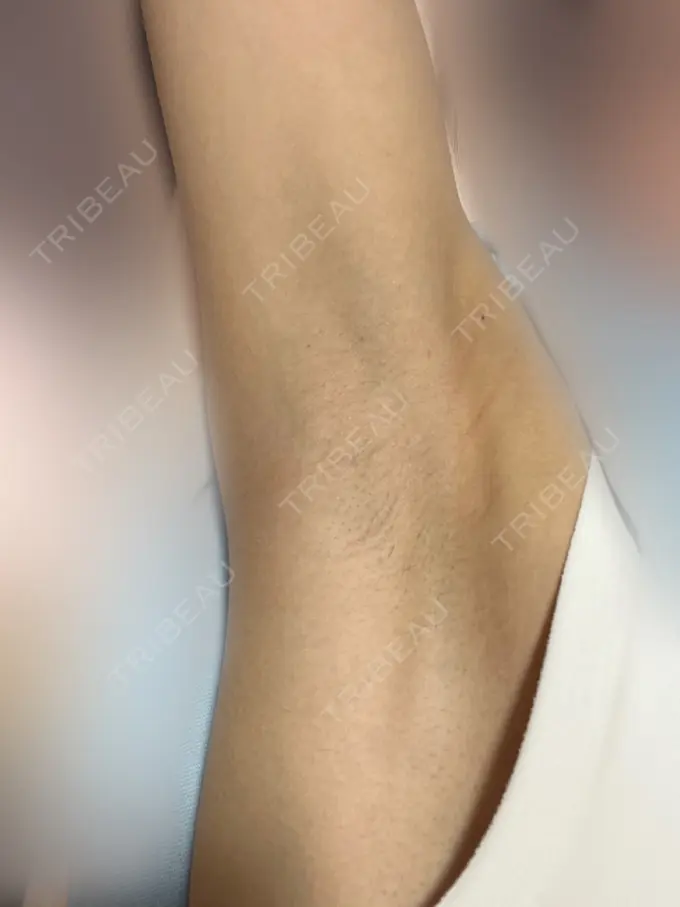 ワキ汗治療（レーザー） エースクリニック 名古屋院 AFTER メイン用