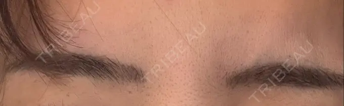 ボトックス（眉間） 湘南美容クリニック 博多院 DAY 7 メイン用