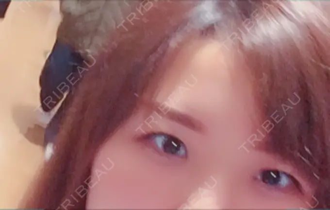 眼瞼下垂（切開） みずほクリニック DAY 73 メイン用