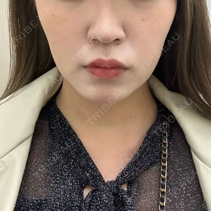 ボトックス（エラ・小顔） 東京シンデレラ美容外科 池袋院 AFTER メイン用