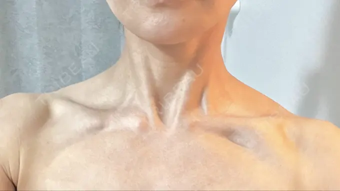 ボトックス（肩） LOUIS CLINIC 二子玉川院【ルイクリニック】 DAY 75 メイン用