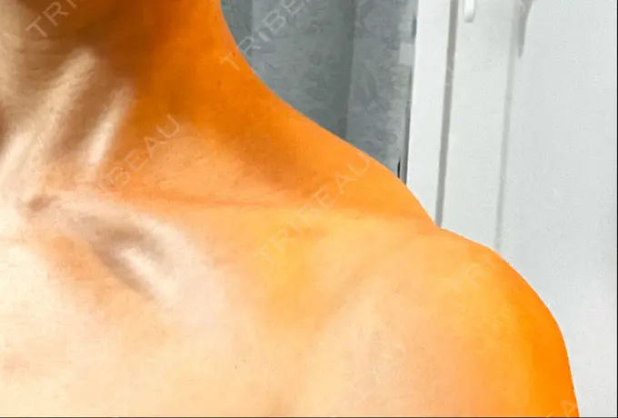 ボトックス（肩） LOUIS CLINIC 二子玉川院【ルイクリニック】 DAY 75 メイン用