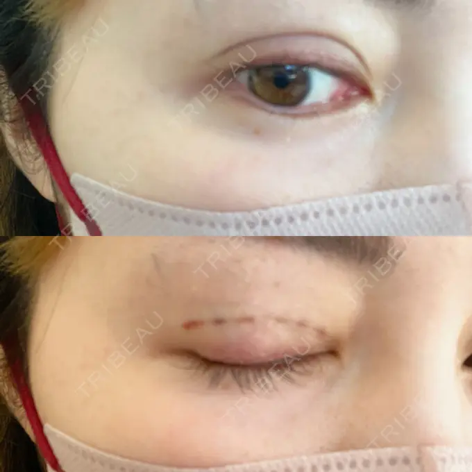 二重埋没 Brandnew Beauty Clinic DAY 0 メイン用