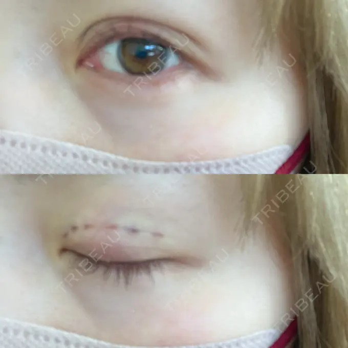 二重埋没 Brandnew Beauty Clinic DAY 0 メイン用