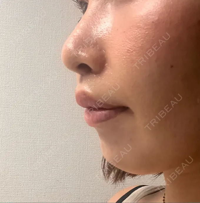 小鼻縮小（切開） / 人中短縮 / 鼻翼挙上 Otus Clinic 【オータスクリニック】 DAY 12 メイン用